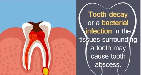 what is the strongest natural antibiotic for tooth infection